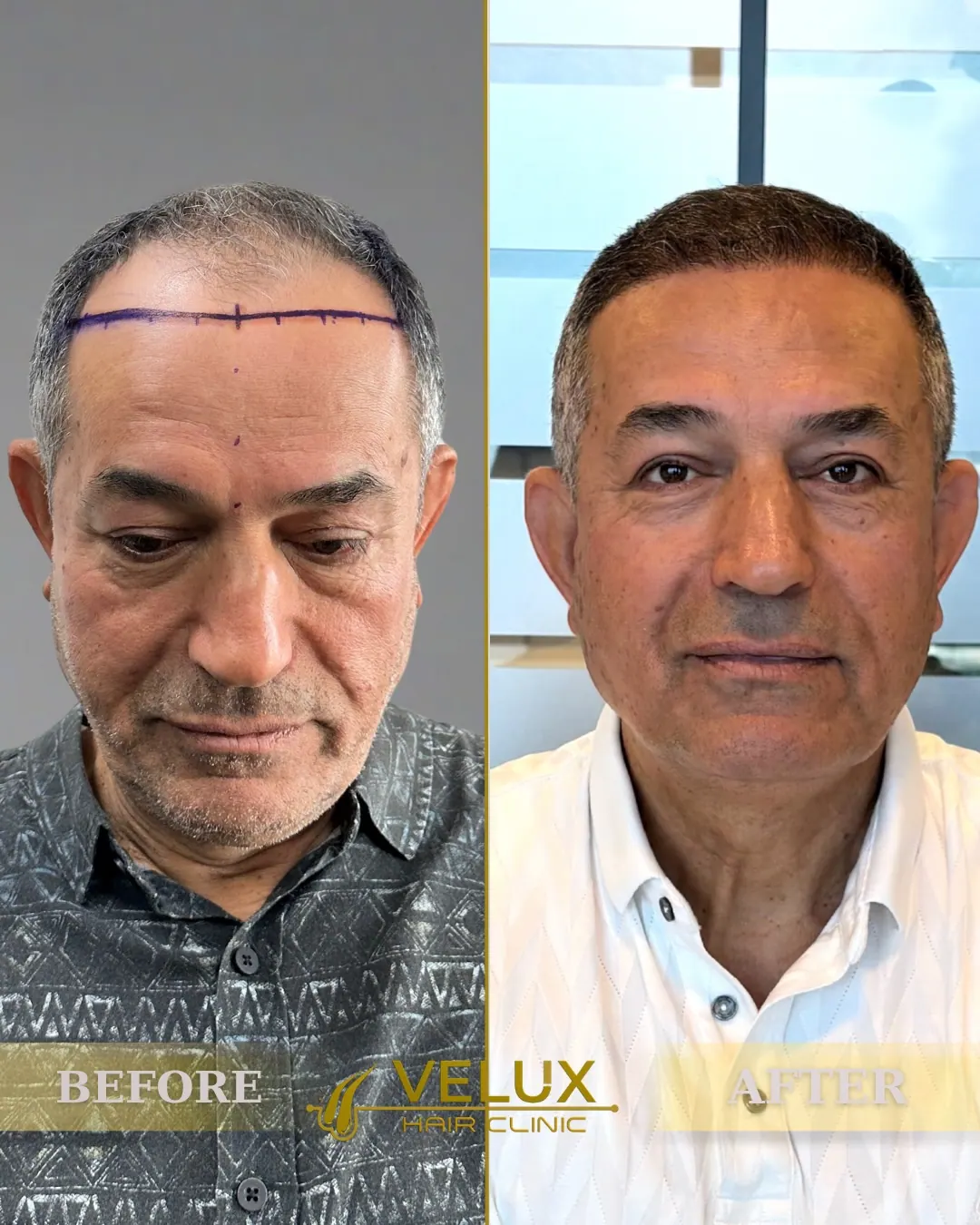 Saç ekimi öncesi ve sonrası, önden görünüm, 6. ay