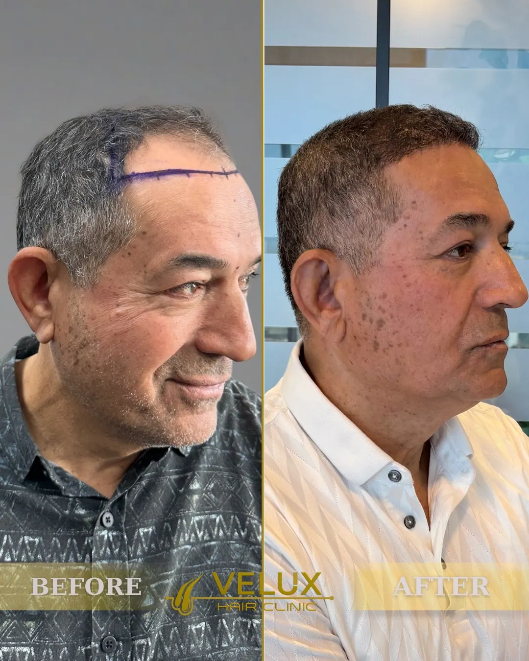 Saç ekimi öncesi ve sonrası, sol yan görünüm, 6. ay