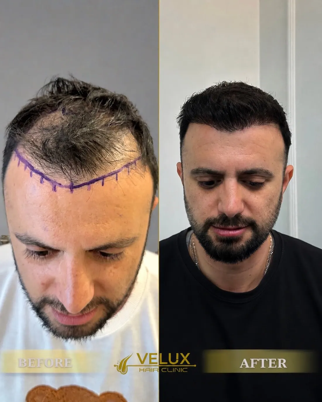 Saç ekimi öncesi ve sonrası, önden görünüm, 1. yıl